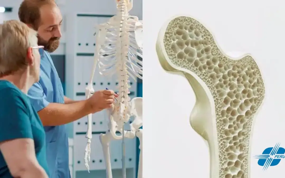 Osteoporosis: Qué es, síntomas, diagnóstico y tratamiento