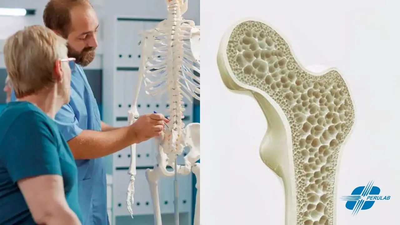 Respuestas sobre la osteoporosis